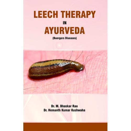 Leech Therapy in Ayurveda (Buergers Diseases)